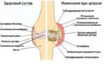 артроз коленный лечение артроза